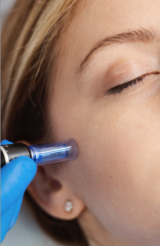 Microneedling - Kurpakke på 4 behandlinger